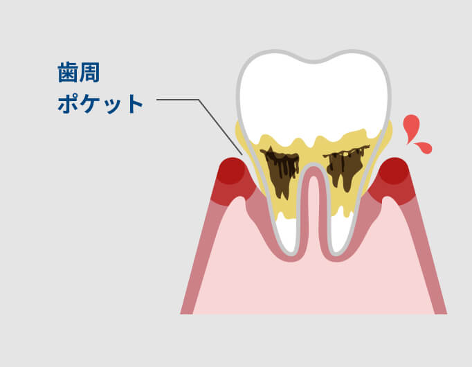 歯周ポケットが深くなってきている様子